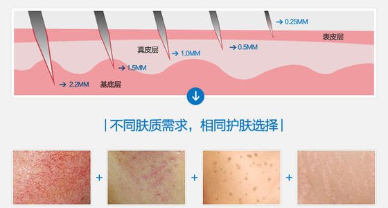 好幾年的痘印做微針痘坑幾次有？祛痘指南請收好