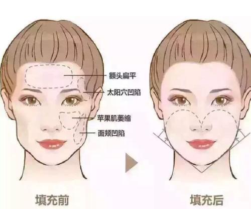 豐臉頰的簡單方法，醫(yī)美簡直就是為顏值開啟的新大陸！