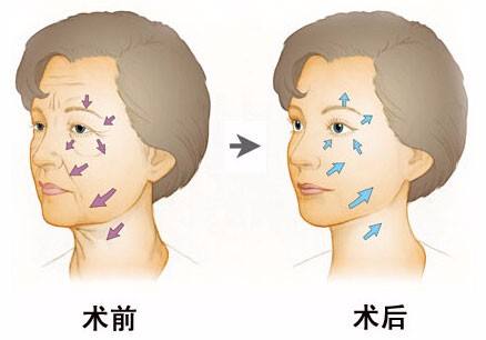 豐臉頰的簡單方法，醫(yī)美簡直就是為顏值開啟的新大陸！