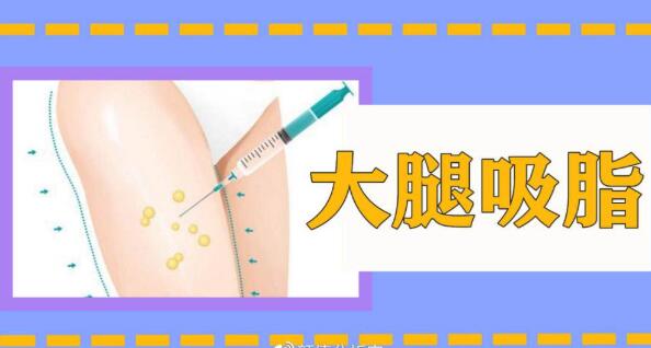 漲知識|大腿吸脂手術恢復期多久？