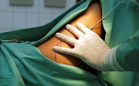 大腿吸脂術后恢復期：