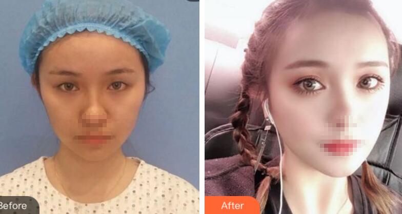 汕頭中心醫(yī)院整形美容科案例