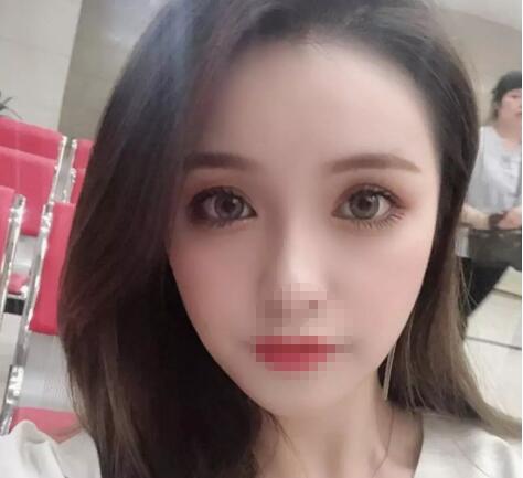 汕頭中心醫(yī)院整形美容科案例