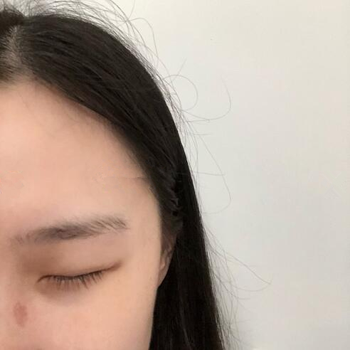 無錫第二人民醫(yī)院美容科去疤痕案例