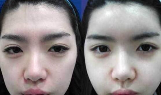 額頭窄豐額頭多少錢？哪些方法沒問題又有？
