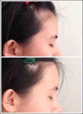 額頭窄豐額頭多少錢？哪些方法沒問題又有？