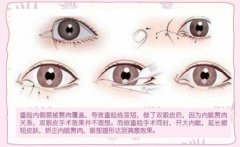 眼睛整形要多少錢？眼部綜合整形手術(shù)能改良的問題