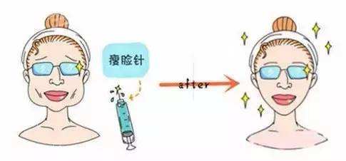 你打完注射瘦臉果不太好？這類臉型這樣打注射瘦臉果才好！