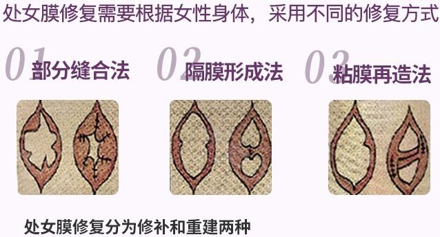 想做處女膜修復(fù)手術(shù)，想了解疼不疼？