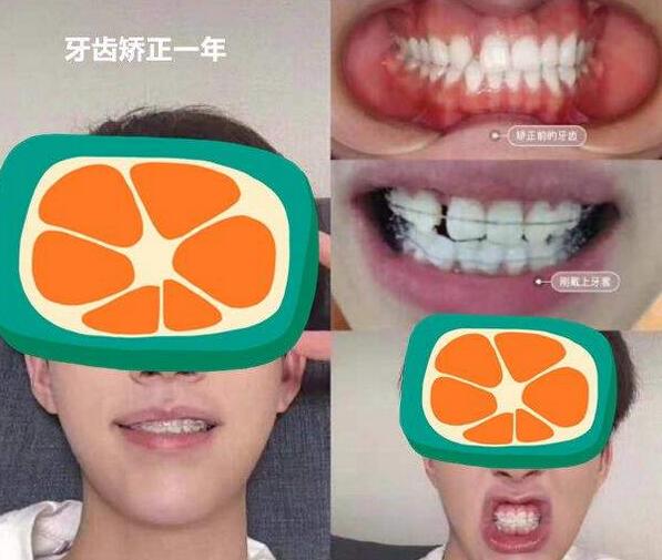 口腔科牙齒矯正案例