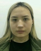 小姐姐做的下頜角長弧度截骨案例，來更新啦…