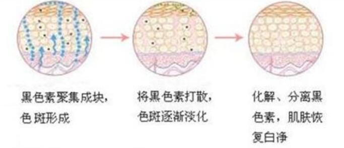 激光祛斑的原理