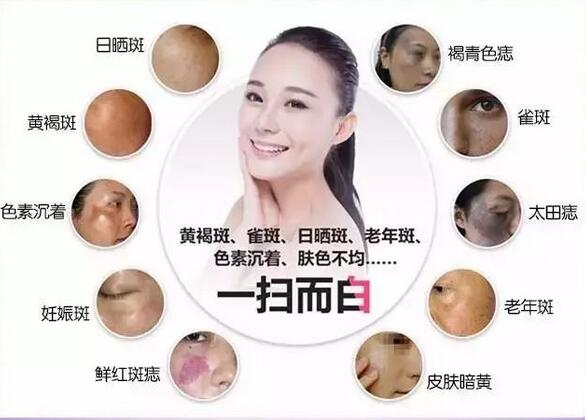 激光祛斑的原理