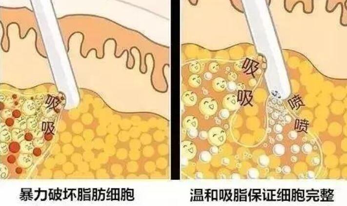 雖然注射瘦腿對肥腿的影響很小，但吸脂對細(xì)腿的果較為好