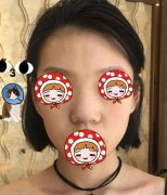 53天的鼻梁歪整形手術(shù)恢復(fù)果圖，鼻子終于挺直身?xiàng)U啦！