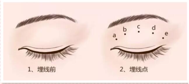 埋線雙眼皮多久恢復(fù)