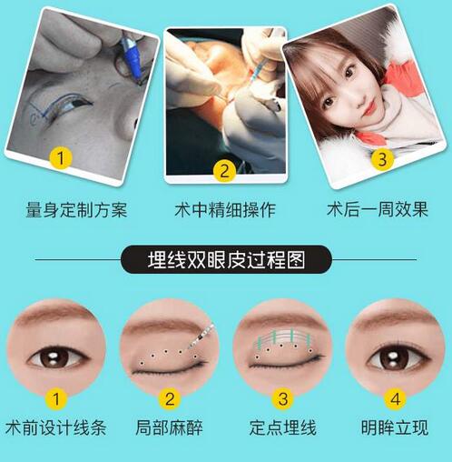 埋線雙眼皮過程及果圖