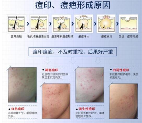 怎么去除痘印痘疤？網(wǎng)上方法太多你可以只認(rèn)準(zhǔn)這一種