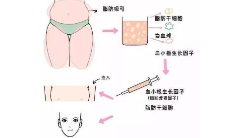 自體脂肪填充下巴手術(shù)原理