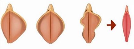 陰唇整形手術(shù)原理