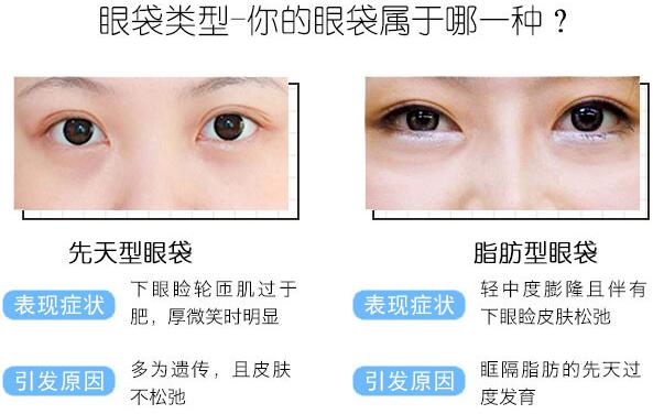 做眼袋手術(shù)多久能恢復(fù)正常