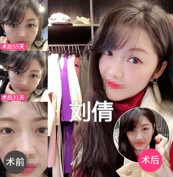 做眼袋手術(shù)多久能恢復(fù)正常