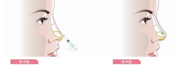 鼻子注射玻尿酸的間隔時間多長才好？