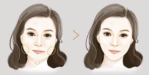 下頜角太肥？咬肌切除手術(shù)說(shuō)不定就能搞定