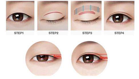 眼皮太厚 做雙眼皮手術需要吸脂嗎