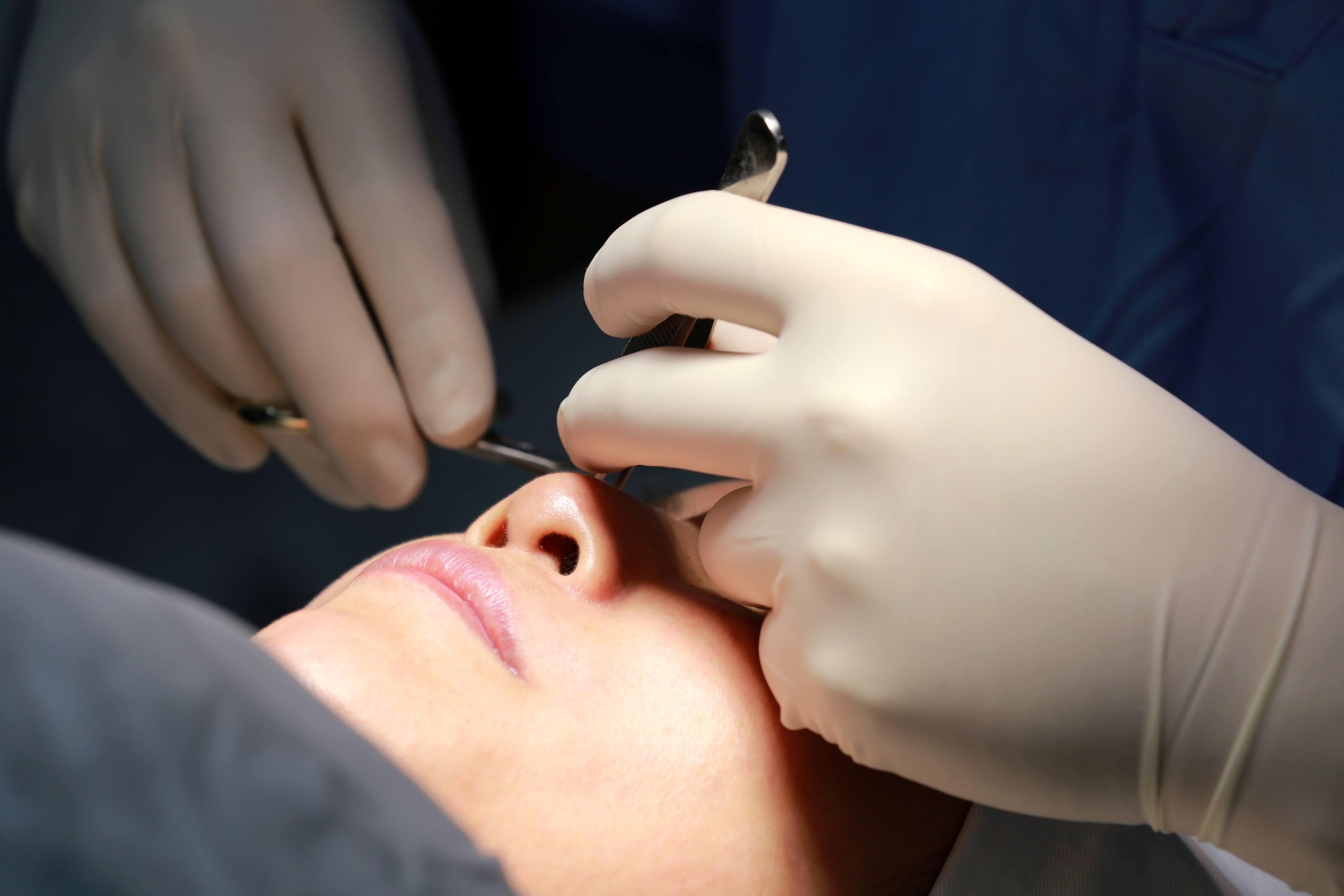 眼皮太厚 做雙眼皮手術需要吸脂嗎