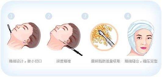 臉盤子大，臉部輪廓整形手術(shù)的果了解一下！