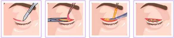 做了激光近視矯正還能做雙眼皮手術(shù)嗎？