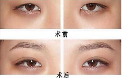 做了激光近視矯正還能做雙眼皮手術(shù)嗎？