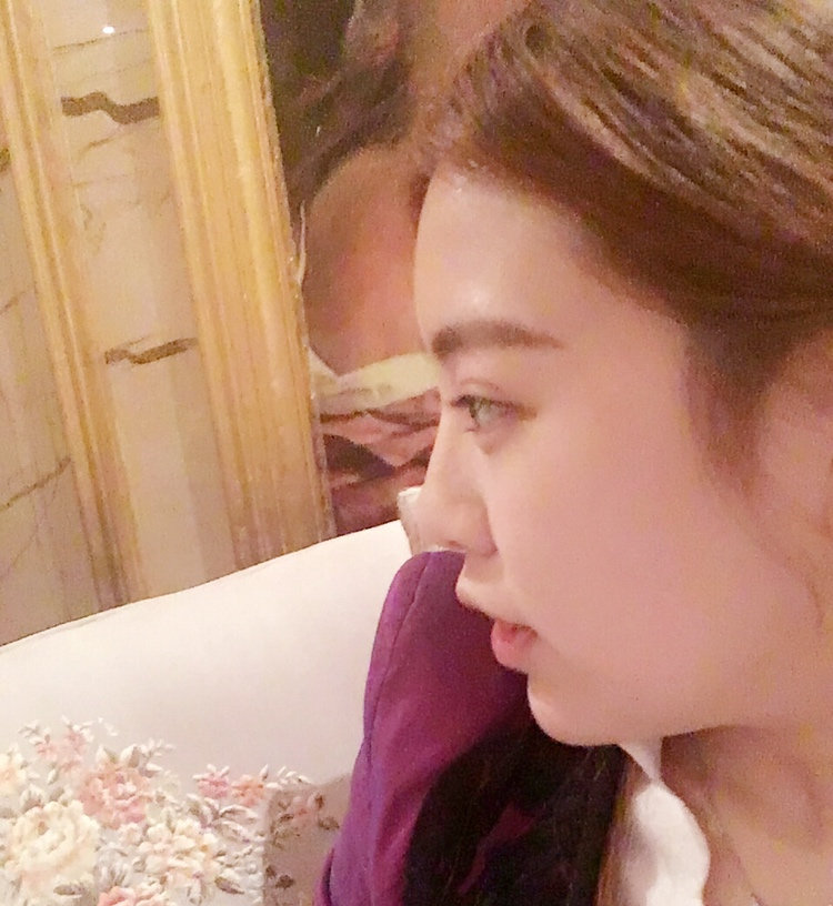 葉麗萍醫(yī)生-鼻子案例-口碑-上海華美整形