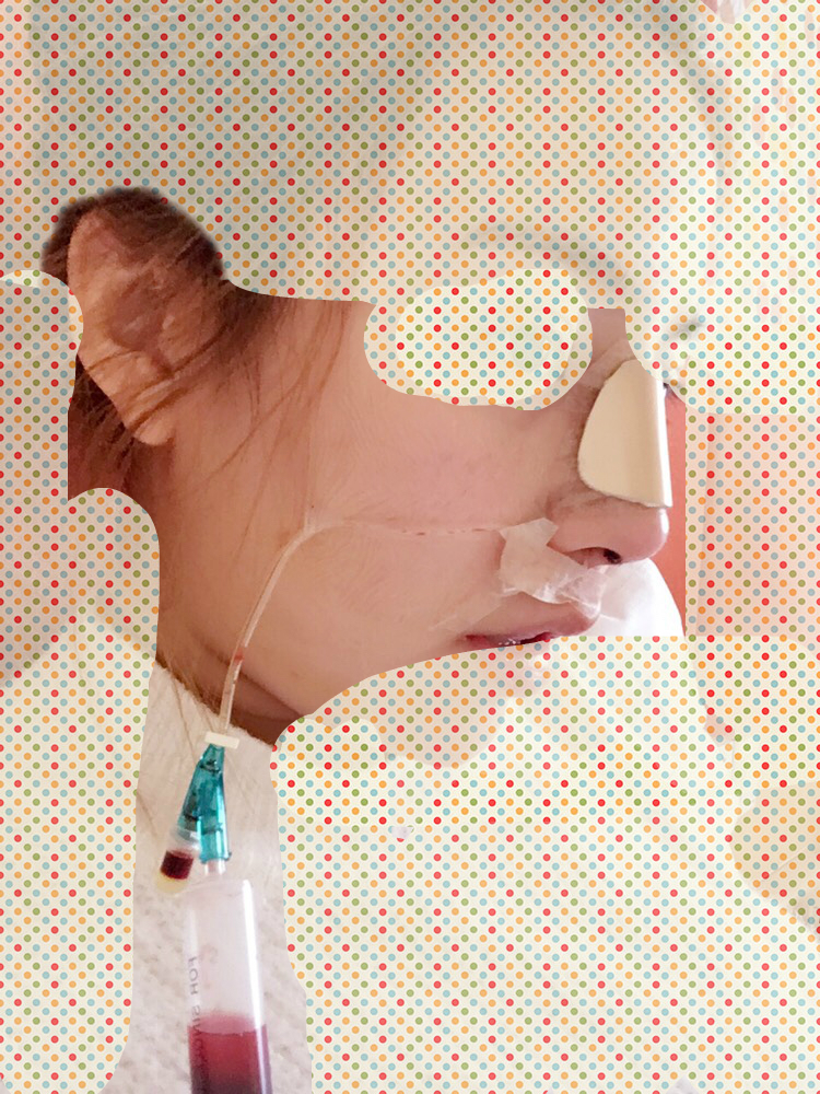 葉麗萍醫(yī)生-鼻子案例-口碑-上海華美整形