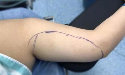 手臂吸脂手術(shù)的副作用