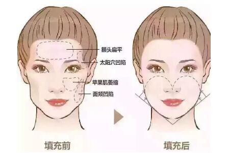 面部脂肪填充后臉特別油是什么情況?