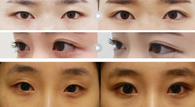 做雙眼皮開眼角為什么要一起做？可能是這個(gè)原因