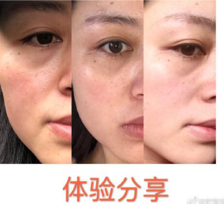 大坪醫(yī)院整形美容科祛斑案例