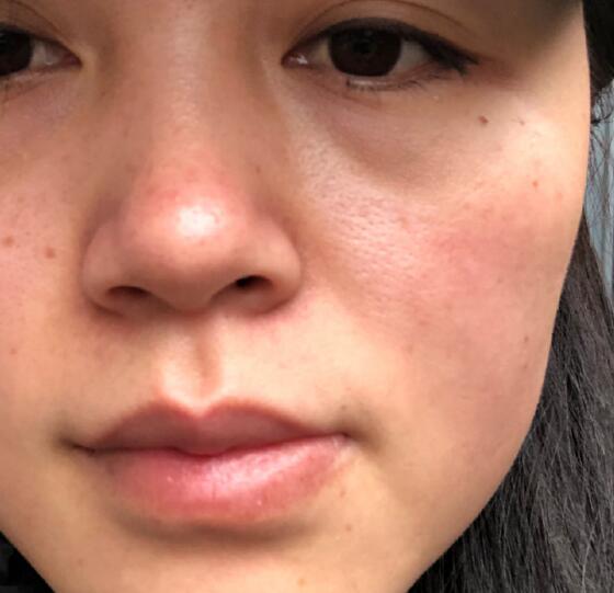 大坪醫(yī)院整形美容科祛斑多少錢