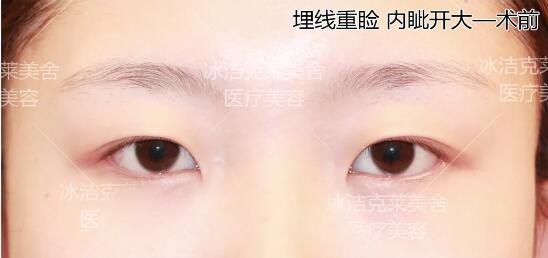 張冰潔埋線雙眼皮 開眼角術前眼部照片
