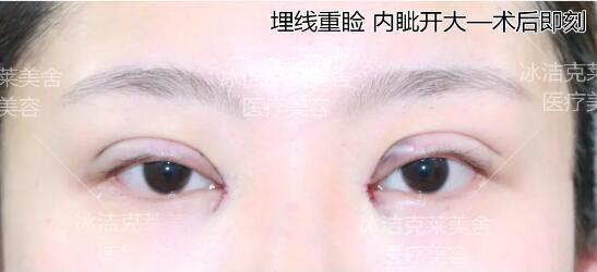 張冰潔埋線雙眼皮 開眼角術后眼部照片