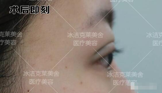 張冰潔埋線雙眼皮 開眼角術后果圖