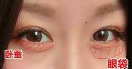 脂肪填充臥蠶有哪些優(yōu)勢(shì)呢?