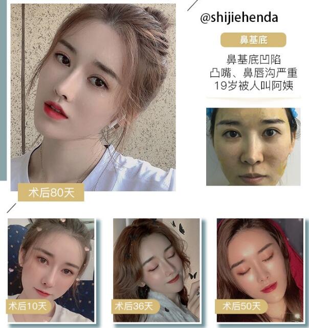 水滴鼻整形手術(shù)