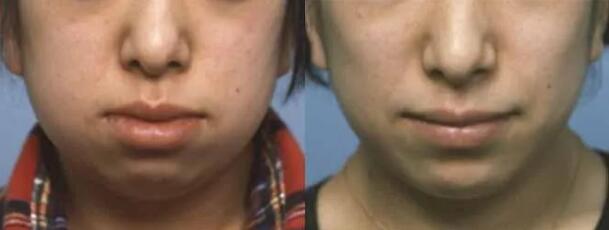 下顎縮小術(shù)和下巴水平切骨術(shù)果圖