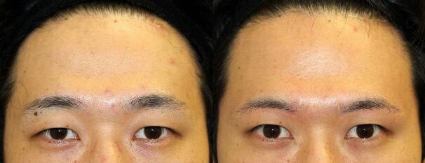 大場(chǎng)教弘——眉下切手術(shù)