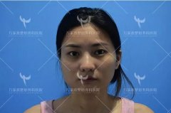 重慶萬家燕整形外科醫(yī)院價目表，王珍祥肥胖下頜角整容案例圖