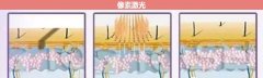 像素激光祛痘得做幾次？祛痘的正確打開方式~