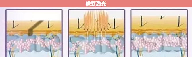 像素激光祛痘得做幾次？祛痘的正確打開方式~